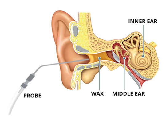 ear wax removal using microsuction in Aberdeen